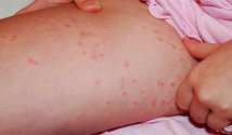 Аллергия на укусы насекомых: симптомы, лечение, профилактика