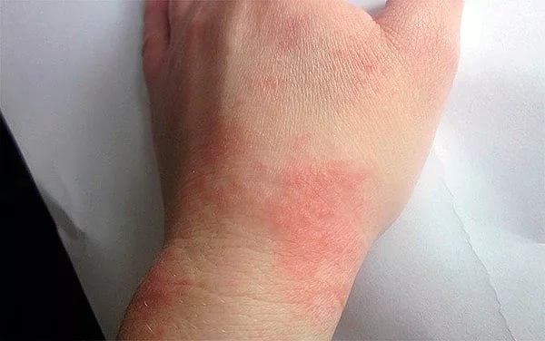 Передозировка Аевит проявляется симптомами