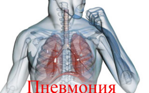 Пневмония