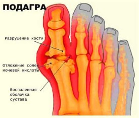 Подагра при отложении солей