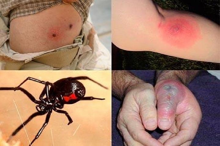 Местные реакции при укусе паука черная вдова