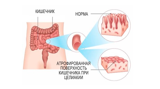  Вред глютена для здоровья